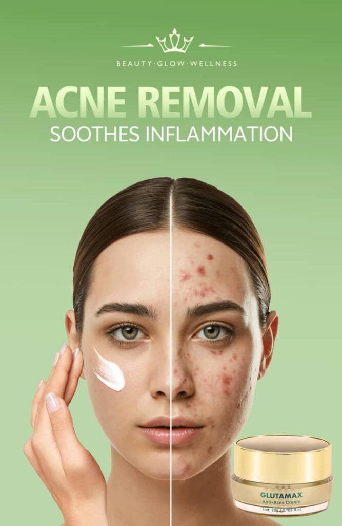 antiacne